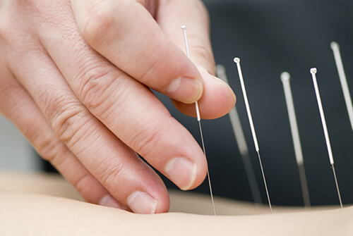 Benefits Of Acupuncture In The Recovery Process